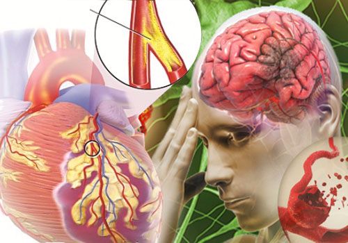 Cảnh báo: 45% các ca đột quỵ não là do bệnh tim mạch gây ra