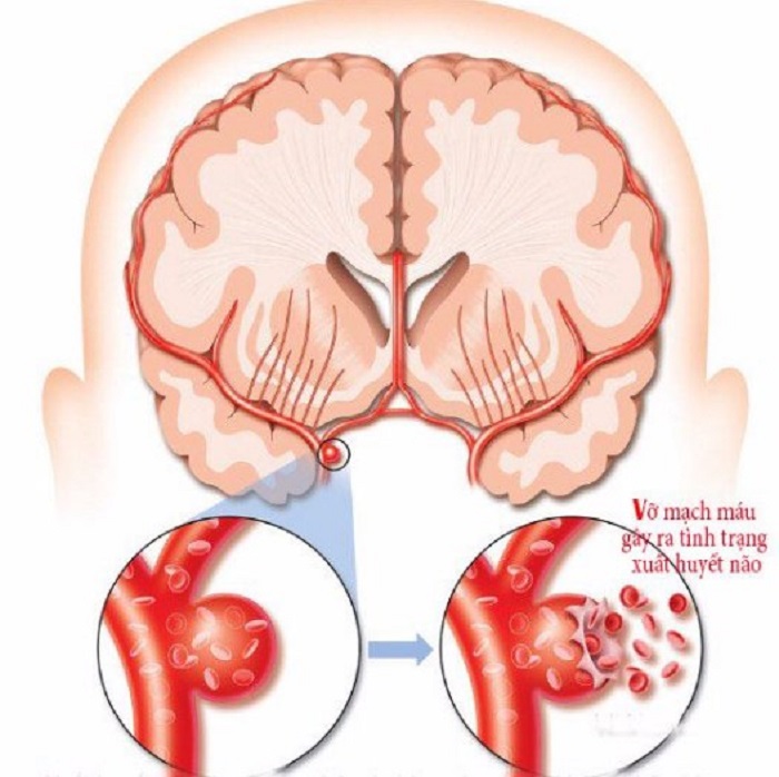Vỡ mạch máu não gây ra tình trạng xuất huyết não nguy hiểm